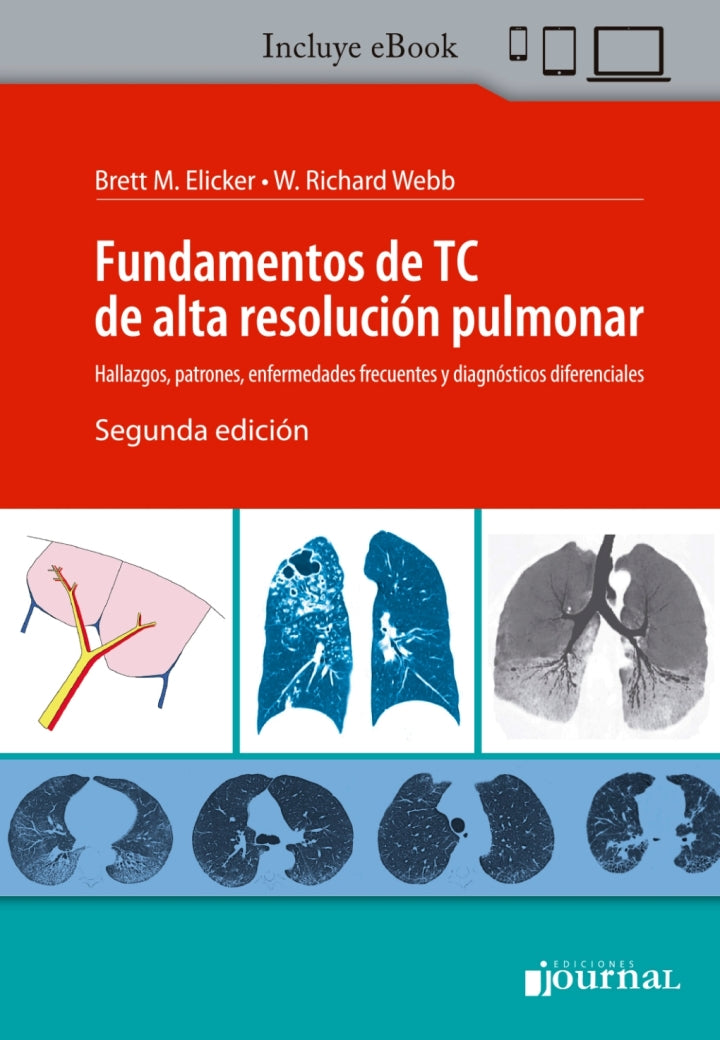 Fundamentos de TC de alta resolución pulmonar 2nd Edition  - E-Book and test bank